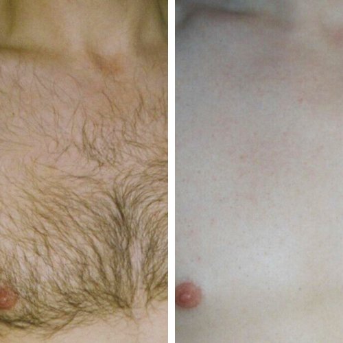 Brusthaare/ Haare per Laser entfernen